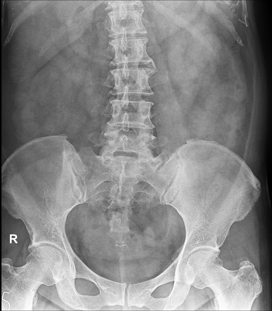 lumbar-xr-mild-scoliosis