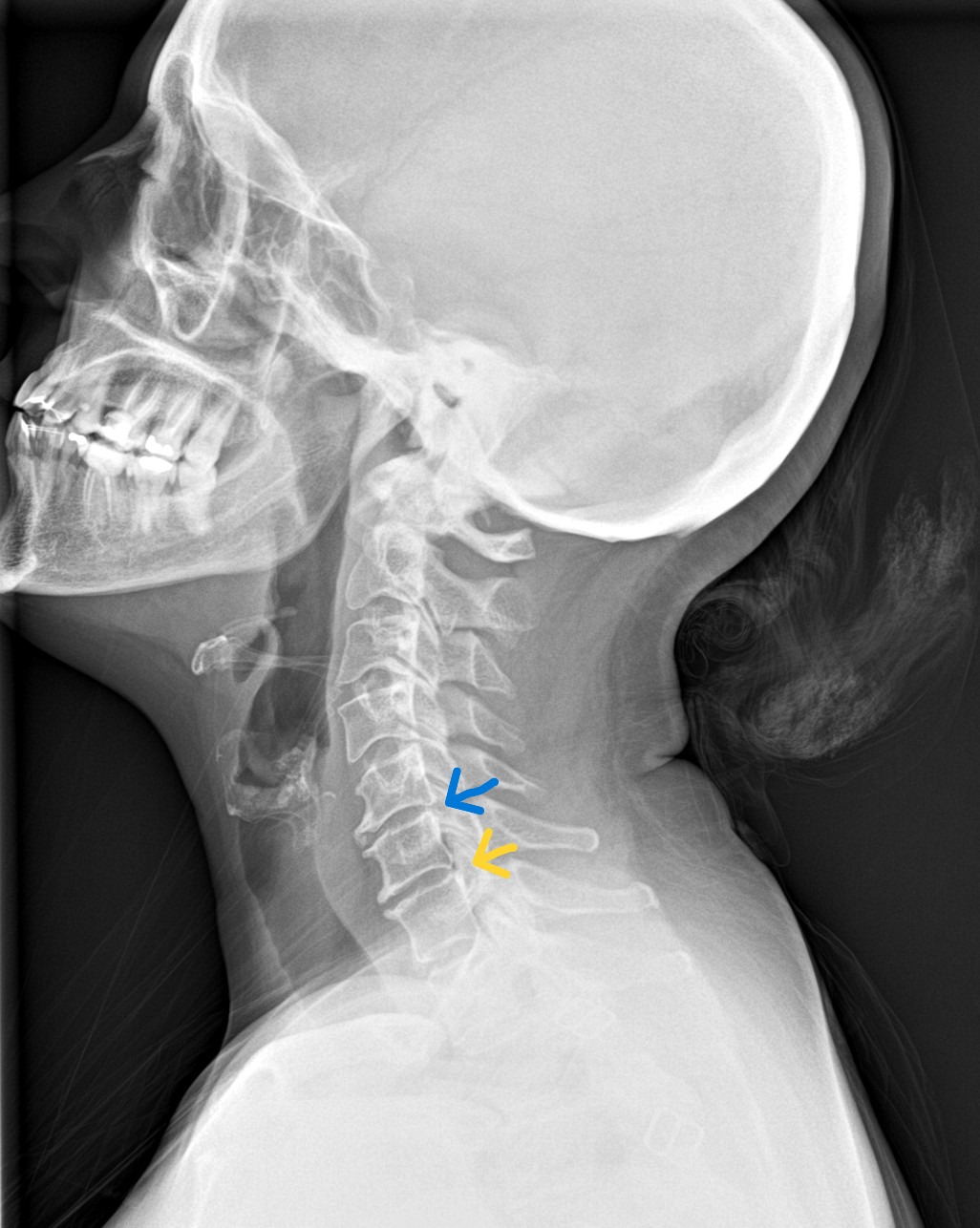 cervical spondylosis